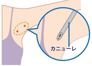 ワキガ手術の種類と費用2-皮下組織吸引法