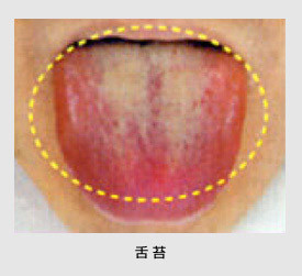 硫化水素が原因の口臭２．舌も忘れずに磨く